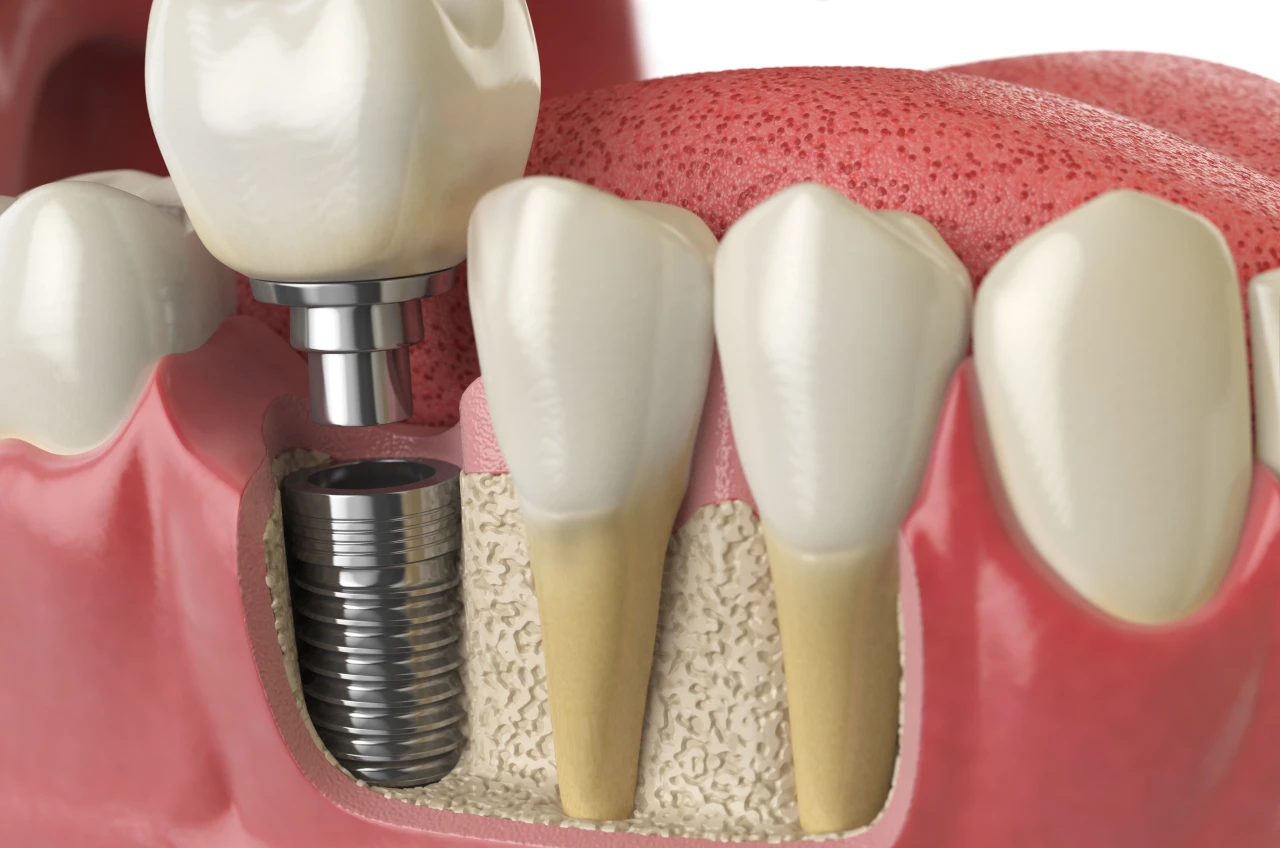 implante dentario na espaco sorriso dentista em recreio rj implante dentario na espaco sorriso dentista em recreio rj