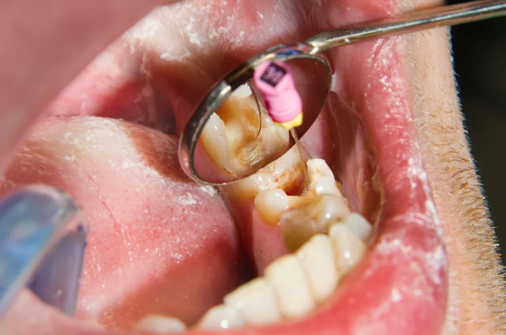 Dentista realizando um tratamento de canal Dentista realizando um tratamento de canal