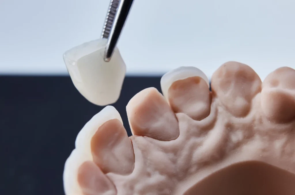 demonstracao de aplicacao de facetas dentarias demonstracao de aplicacao de facetas dentarias
