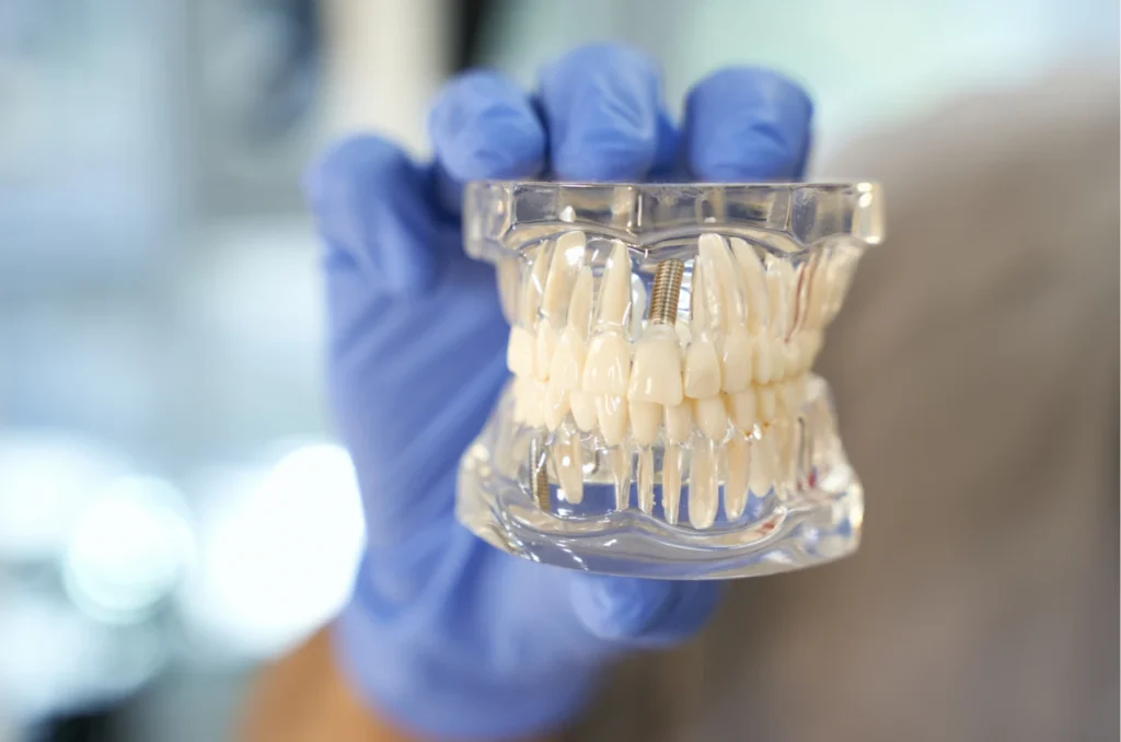 molde com implastes dentarios molde com implastes dentarios