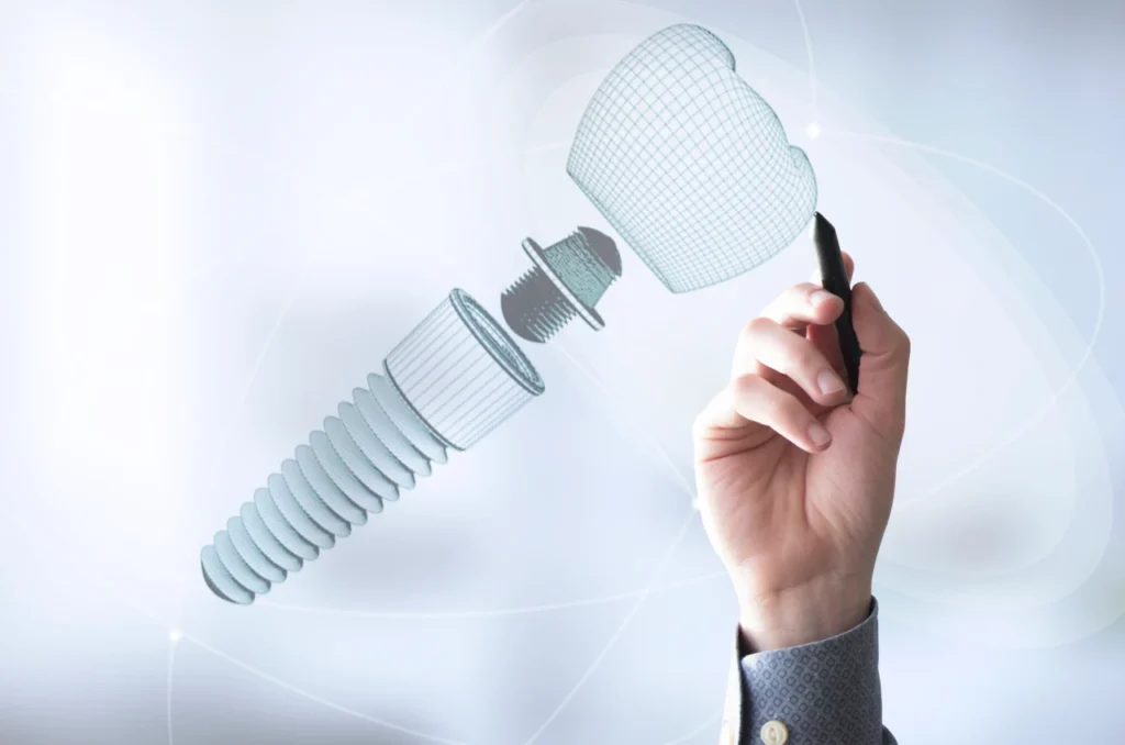 Tecnologia Esta Transformando os Implantes Dentarios Tecnologia Esta Transformando os Implantes Dentarios