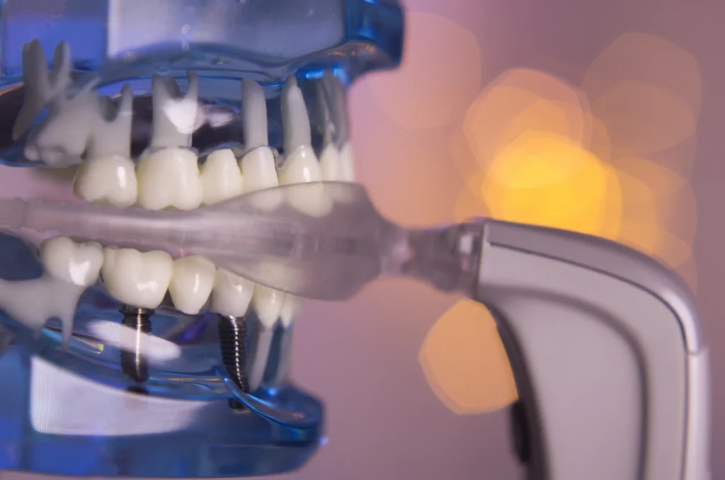 Tecnologia nos Implantes Dentarios Tecnologia nos Implantes Dentarios