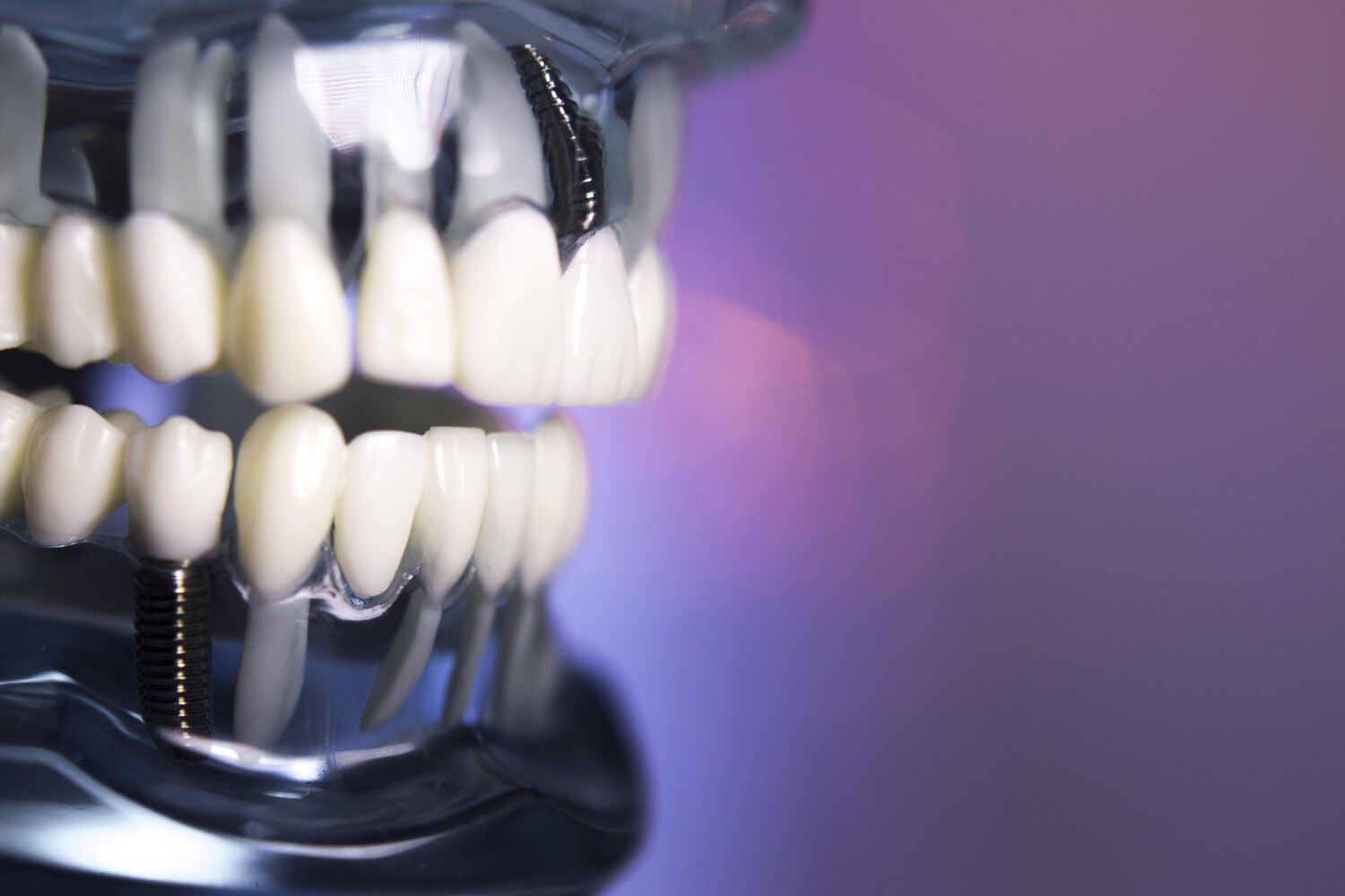 close up dentures against purple background 1048944 30498417 close up dentures against purple background 1048944 30498417