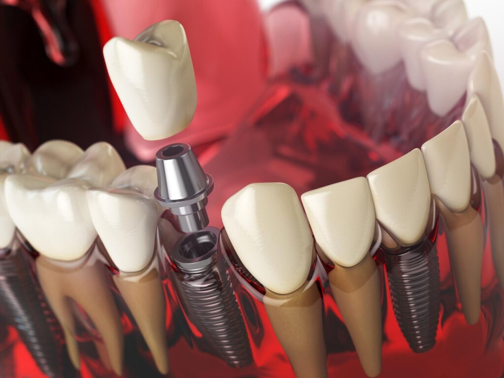 tooth implant model human teeth gums denturas dental medicine stomatology concept 505080 1600 tooth implant model human teeth gums denturas dental medicine stomatology concept 505080 1600
