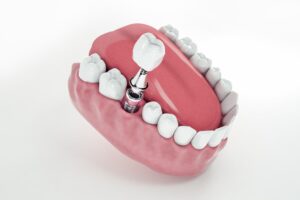 view from false tooth implant fixed jawbone 3d 3d illustration 78895 2201 view from false tooth implant fixed jawbone 3d 3d illustration 78895 2201