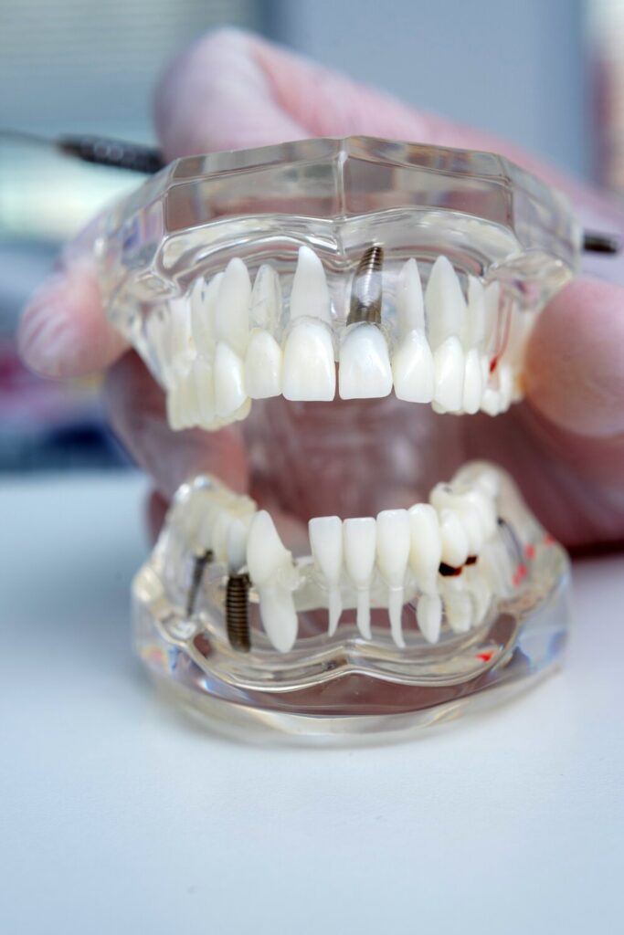doctor orthodontist holds his hand model teeth with implants 114354 342 doctor orthodontist holds his hand model teeth with implants 114354 342